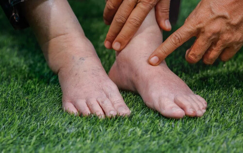 Flüssigkeitsretention in Füßen